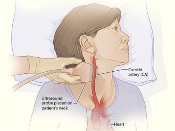 Carotid Ultrasound Image