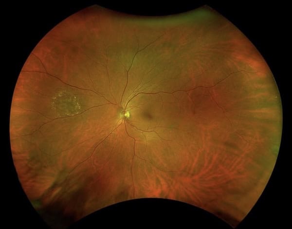Optomap eye image