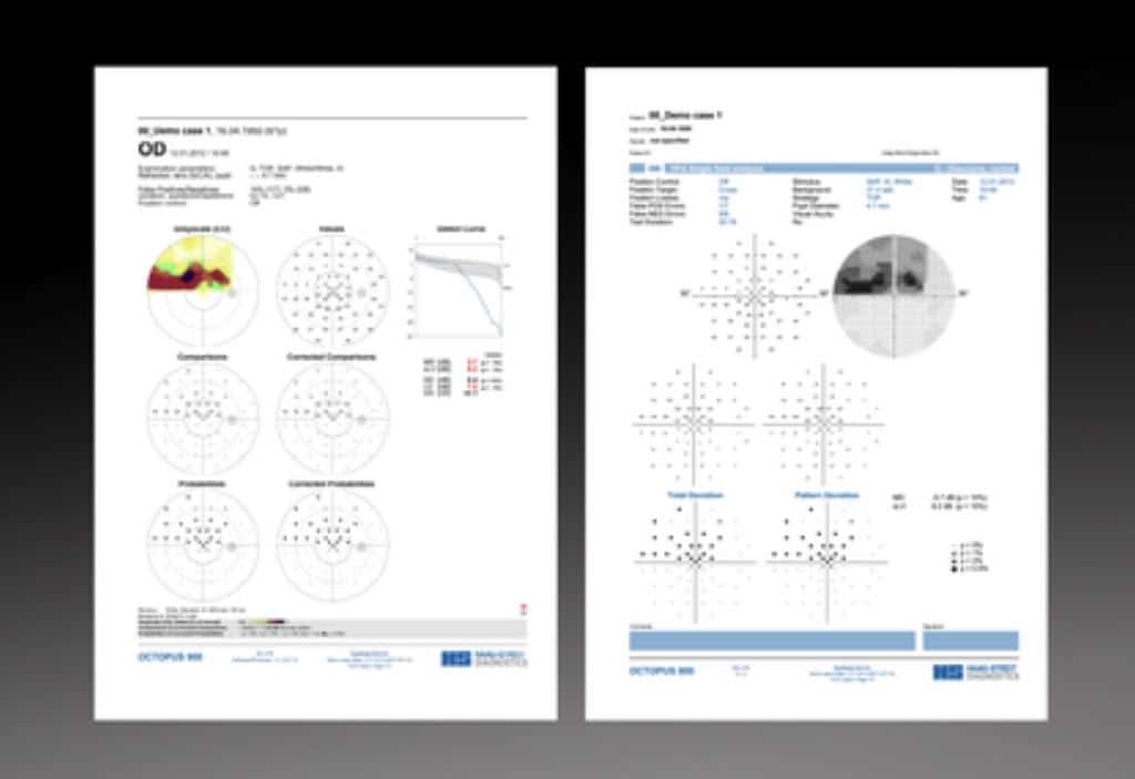 Visual Field test results